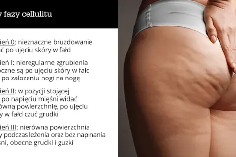 Cellulit na udach: Skuteczne sposoby na gładką skórę (Dieta, Ćwiczenia)