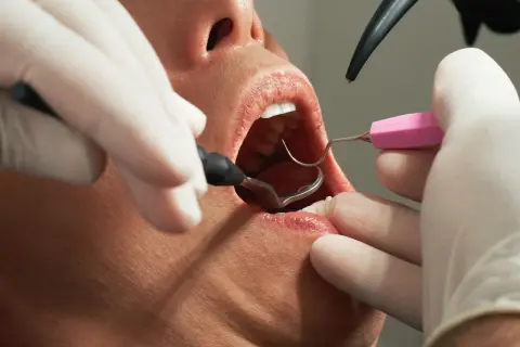 Dentysta używa lusterka i narzędzi do odbudowy zęba.