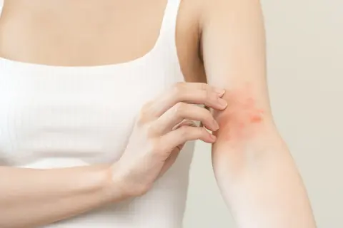 Frau kratzt sich am Arm mit rotem Ausschlag. Sie sucht nach Hausmittel gegen Juckreiz.