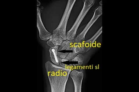 Radiografia del polso con vite nel scafoide mano, evidenziati radio e legamenti.