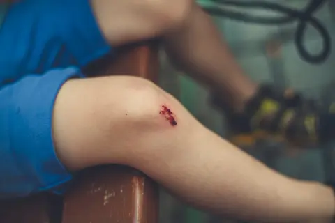 Dziecko z otartym kolanem, które może być jednym z objawów tężyczki.