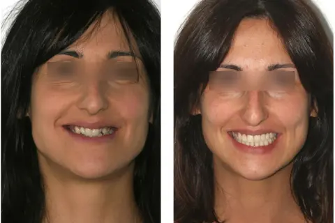 Sorriso prima e dopo: miglioramento estetico del canino incluso e dei denti.