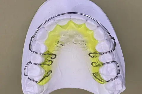 Modello di gesso con una placca di Hawley colorata di giallo, pronta per correggere l'allineamento dentale.