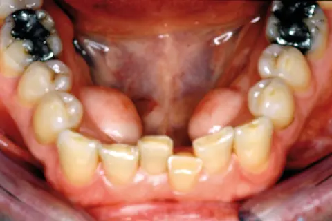 Vista ravvicinata della bocca con denti inferiori e superiori visibili. Si nota una piccola protuberanza carnosa, forse un'esostosi, sulla gengiva.