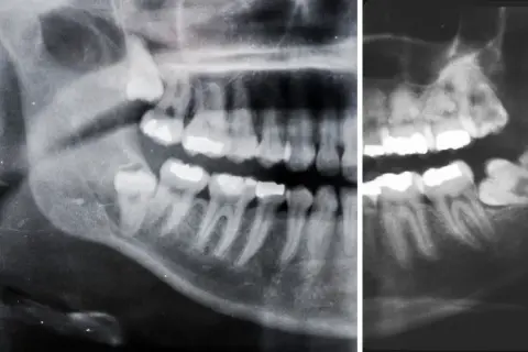 Radiografia panoramica mostra un dente incluso, probabilmente un molare, intrappolato nell'osso mascellare, impedendone la corretta eruzione.