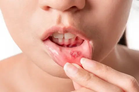 Widoczne jest owrzodzenie na wewnętrznej stronie wargi, które pokazuje, jak wygląda afta.