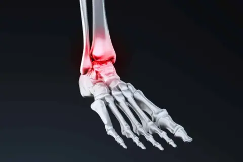 Anatomie du pied humain, mettant en évidence l'astragale os et les zones enflammées en rouge.