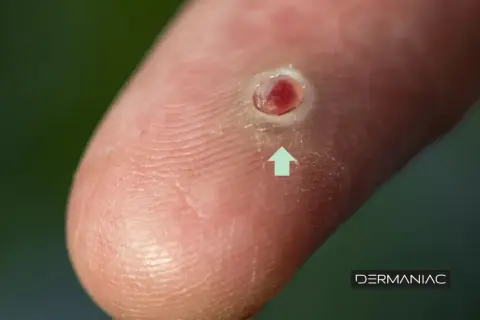 Un grano enquistado en un dedo, con una flecha verde apuntando a la lesión.
