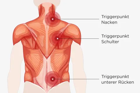 Muskelansicht des Rückens mit markierten Triggerpunkten im Nacken, an der Schulter und im unteren Rücken, die auf hws myogelose hinweisen.