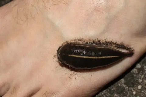 Une sangsue de rivière s'est accrochée au pied, une rencontre désagréable lors d'une baignade.