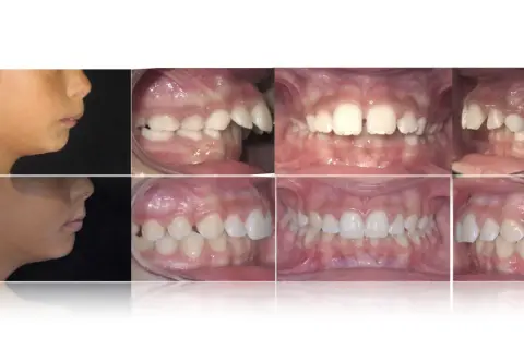 Prima e dopo: profilo di un bambino con apparecchio denti sporgenti e immagini ravvicinate dei suoi denti prima e dopo il trattamento ortodontico.