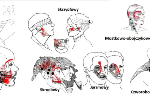 Ilustracje pokazują punkty bólu związane ze stawem skroniowo-żuchwowym. Różne obszary głowy i szyi zaznaczone czerwonymi kropkami wskazują potencjalne źródła bólu.