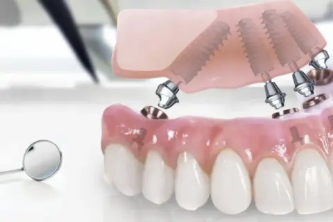 Model szczęki z implantami, gotowy do montażu. Rozważ implanty w Turcji dla pięknego uśmiechu.