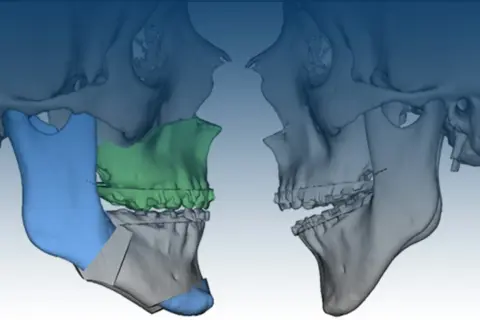 Modellazione 3D di un intervento maxillo-facciale per correggere una terza classe, evidenziando le aree di osteotomia e i potenziali rischi.