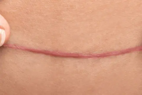 Des doigts écartent la peau pour révéler une cicatrice rosée. Un remède de grand-mère pour effacer les cicatrices, un espoir de guérison.