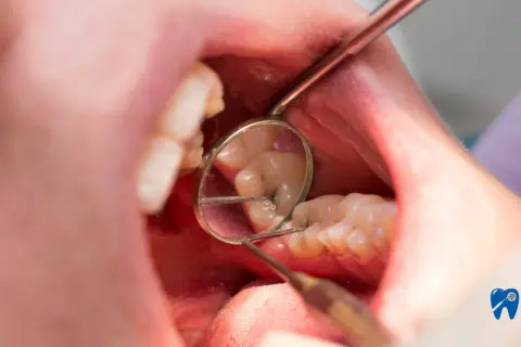 Dziura w zębie? Jak zabezpieczyć ubytek do wizyty u dentysty