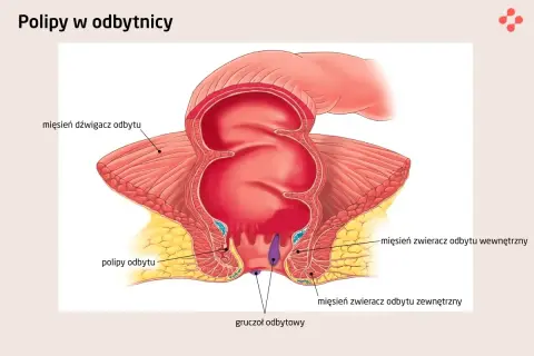Anatomia odbytnicy z widocznymi polipami. Ilustracja pokazuje mięsień dźwigacz odbytu, mięśnie zwieracze odbytu wewnętrzny i zewnętrzny oraz gruczoły odbytowe.