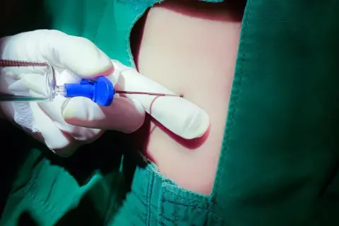 Precyzyjne znieczulenie przewodowe wewnątrzustne. Ręka w rękawiczce trzyma strzykawkę z igłą, gotową do podania środka znieczulającego.