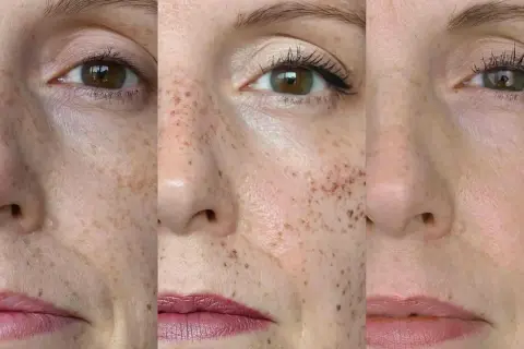 Trzy zbliżenia twarzy z piegami. Widać, jak można je subtelnie podkreślić, by nadać cerze naturalnego blasku i **cultivate** jej piękno.