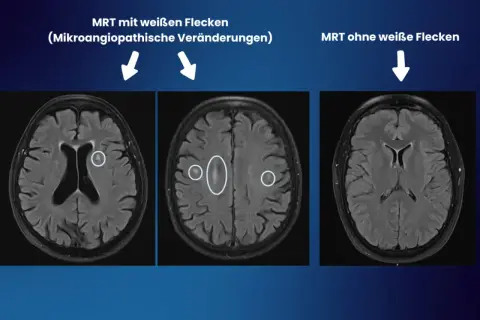 MRT-Aufnahmen zeigen weiße Flecken im Gehirn, die auf mikroangiopathische Veränderungen hindeuten. Diese können fazekas 2 symptome verursachen.