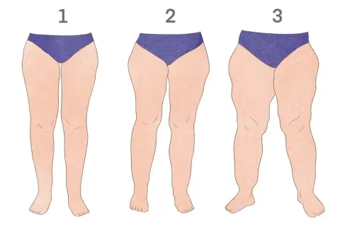 Ilustracja pokazuje progresję lipodemia objawy: nogi szczupłe (1), lekko zaokrąglone (2) i wyraźnie opuchnięte (3).