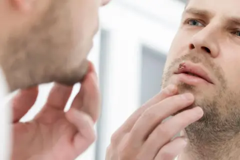 Mężczyzna z opryszczką na ustach zastanawia się, czy przeziębienie a znieczulenie u dentysty to problem.