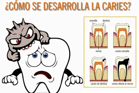 Monstruo atacando un diente triste. Diagramas de etapas de caries dental.