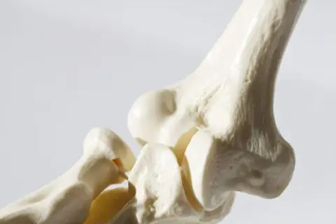 Jaki lek na osteoporozę? Poznaj skuteczne opcje leczenia i ich działanie