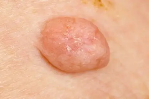 HPV: Dermatolog czy urolog? Który specjalista pomoże w infekcji?