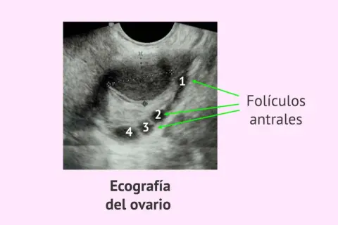 Ecografía ovárica que muestra varios folículos antrales, identificados con números del 1 al 4.