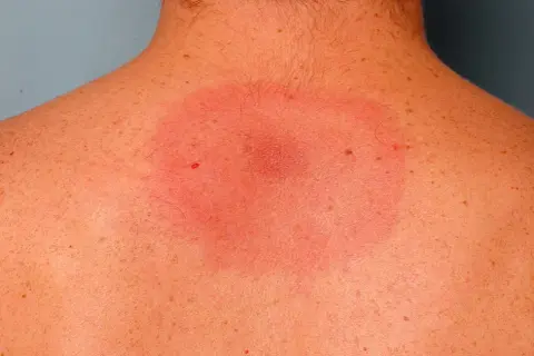 Consecuencias de una garrapata mal quitada en persona y cómo actuar