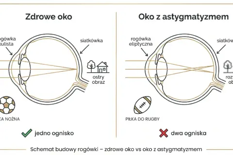 Astygmatyzm a prawo jazdy: zdrowe oko skupia światło na siatkówce, dając ostry obraz. Oko z astygmatyzmem tworzy dwa ogniska, co może wpływać na widzenie podczas prowadzenia pojazdu.
