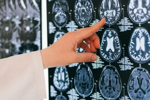 Guz mózgu objawy psychiczne - niebagatelizuj tych sygnałów zdrowotnych