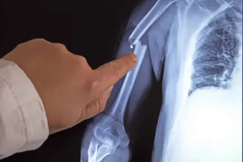Röntgenbild eines gebrochenen Oberarms. Ein Finger zeigt auf die Bruchstelle. Möglicherweise ein Hinweis auf Knochenkrebs im Alter.