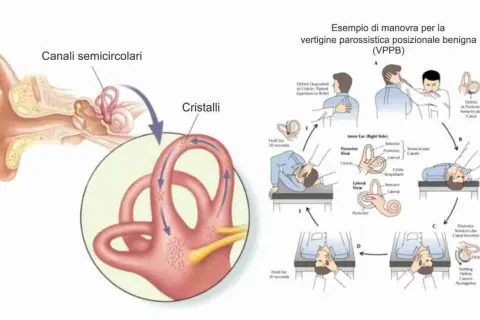 Illustrazione dell'orecchio interno e manovra per le vertigini parossistiche posizionali (VPPB), con i canali semicircolari e i cristalli.