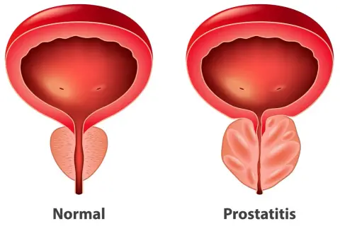 Porównanie pęcherza i prostaty: zdrowa prostata vs. przerost prostaty. Widoczny nacisk na gruczoł krokowy.