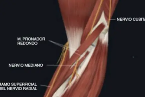 Edema muscular pronador redondo: ¿Por qué duele tu antebrazo?