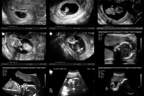 Badania prenatalne 2 trymestr: Twój przewodnik po zdrowiu dziecka