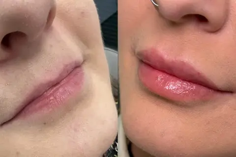 Usta przed i po zabiegu z 1 ml kwasu. Widoczna różnica w objętości i kształcie warg.