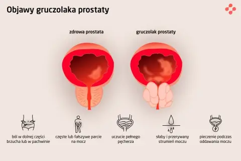Porównanie zdrowej prostaty i gruczolaka. Objawy raka prostaty: ból brzucha, częste parcie na mocz, słaby strumień, pieczenie.