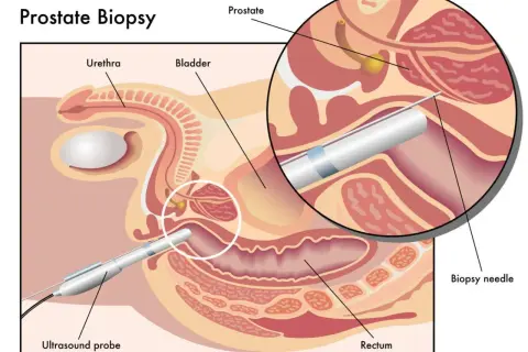 Illustration zeigt, was ist eine biopsie der Prostata. Eine Biopsienadel wird durch das Rektum eingeführt, um Gewebe zu entnehmen.