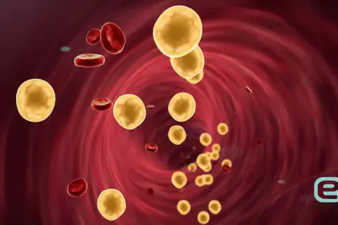 Żółte kuleczki cholesterolu i czerwone krwinki w naczyniu krwionośnym. Wysoki cholesterol może prowadzić do problemów zdrowotnych.