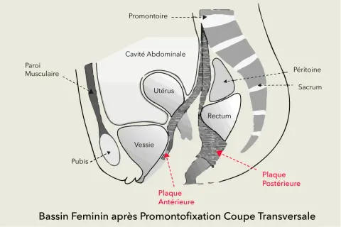 Coupe transversale du bassin féminin montrant la convalescence après promontofixation, avec utérus, vessie, rectum et plaques de fixation.
