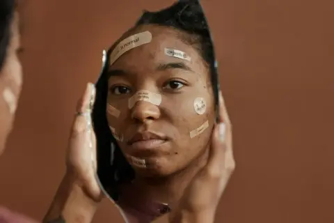 Riflesso di un volto con cerotti che recitano "acne is normal", "imperfect", "i'm not my skin", quando ti fanno sentire una nullità.