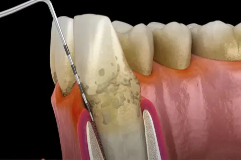 Narzędzie dentystyczne usuwa kamień nazębny z korony zęba i linii dziąseł.