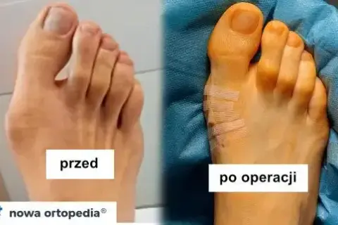 Jakie zabiegi na haluksy? Pełny przewodnik: od fizjoterapii po operacje