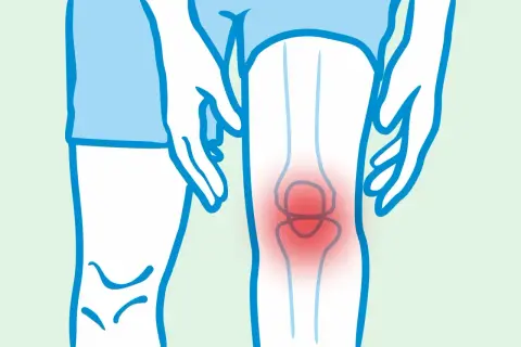 Ból kolana, objaw spondyloartropatii. Rokowanie zależy od wczesnej diagnozy i leczenia.