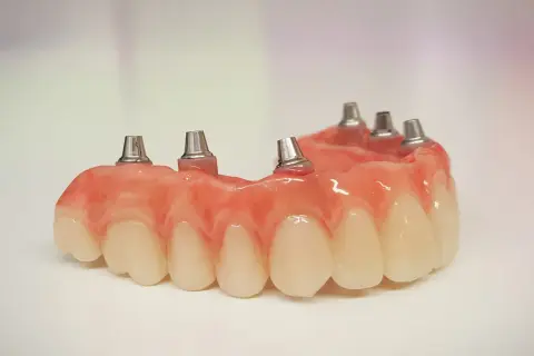 Proteza częściowa na NFZ z metalowymi elementami mocującymi, gotowa do implantacji.