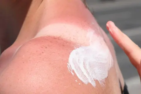 Schulter mit starkem Sonnenbrand, Rötungen und beginnenden Brandblasen. Eine Hand trägt Sonnencreme auf, um die Haut zu beruhigen.