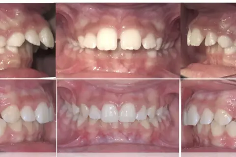Denti sporgenti prima e dopo: vista laterale e frontale di un sorriso con denti allineati e corretti.
